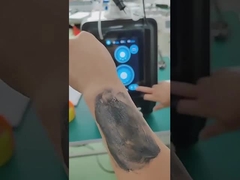 P9 Nd Yag Laser Picosecond Laser Tattoo Verwijderingsapparaat